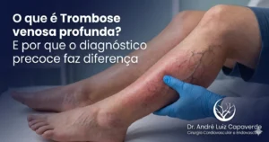 trombose venosa profunda e diagnóstico precoce em cirurgia vascular
